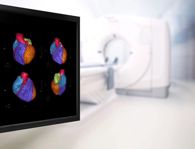 Angiotomografia coronariana: o que é, principais indicações e como é feito o exame